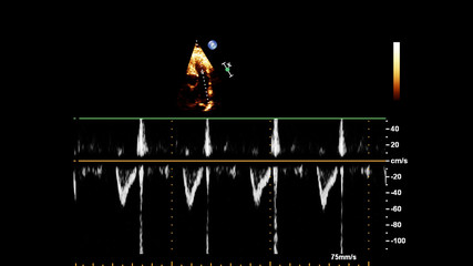 Screen of echocardiography (ultrasound) machine.