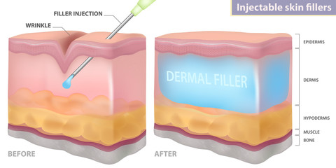 Injection filler injection under the skin, vector illustration - obrazy, fototapety, plakaty
