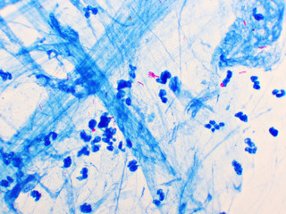 Mycobacterium tuberculosis positive (small red rod) in sputum smear, acid-fast stain, analyze by...