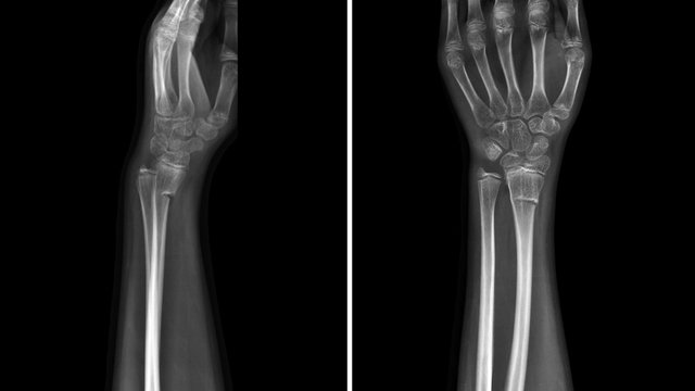 Film X ray wrist radiograph show wrist bone broken (torus or buckle fracture). The patient has wrist pain, swelling and deformity. Medical imaging and technology concept