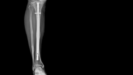 Film leg X-ray radiograph showing leg bone broken (tibia fracture) which treated by close reduction...