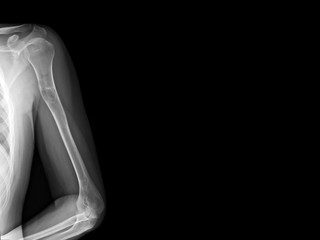 Film X-ray shoulder radiograph show Aneurysmal bone cyst disease (ABC) which benign tumor of bone...