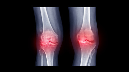 Film X ray knee show rheumatoid arthritis disease (RA knee disorder) with Windswept deformity...