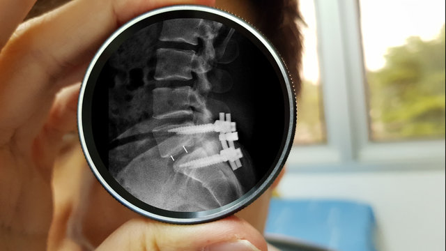Doctor‘s hand holding magnified lens its reflex of lens show film X ray of spinal stenosis disease treated by surgery (decompressive laminectomy with fusion and fixation with pedicle screw and rod).