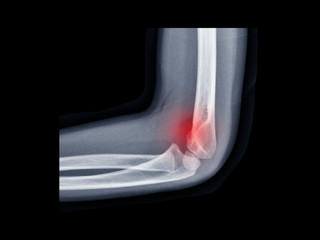 Film X-ray elbow radiograph show elbow bone broken (supracondylar of distal humerus fracture with...