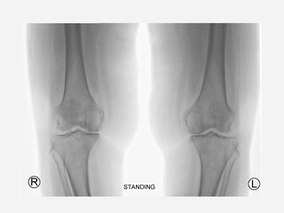 Film standing X ray knee radiograph show degenerative osteoarthritis disease (OA knee disorder). The patient has knee pain and walking problem. Medical technology concept