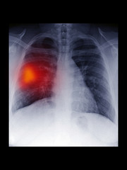 Film x-ray chest radiograph (CXR) show collapsed lung (atelectasis disease). Collapse of lung cause...