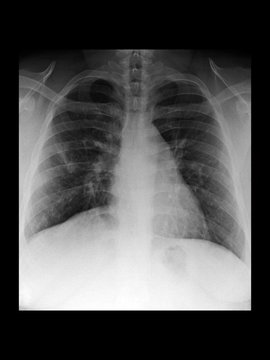 Film X-ray Chest Radiograph Show Collapsed Lung (atelectasis Disease). Collapse Or Closure Of Lung Cause Reduced Gas Exchange And Breathing Difficult. Medical Imaging Concept.