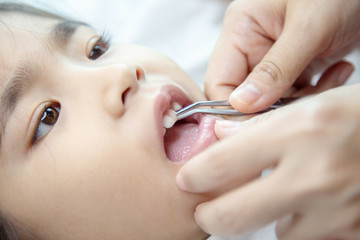 dentist pull mulky tooth of asian kids with hygine equipment