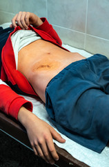 Young teenage boy in hospital. Concept for wound from surgery.