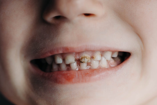 Close-up of preschooler's mouth with teeth damaged by caries.