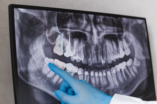 Doctor points wisdom tooth in dental x-ray.
