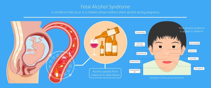 Fetal alcohol spectrum syndrome disorders conditions mother drank during pregnancy cause brain damage and birth defect in children