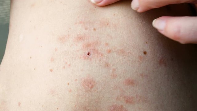 skin rash treatment on woman body. Shingles, Disease, Herpes zoster, varicella-z, lichenoid dermatitis