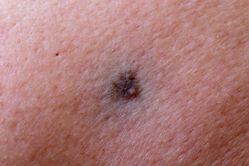 The initial stage of melanoma