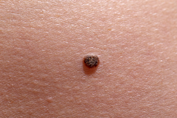 The initial stage of melanoma