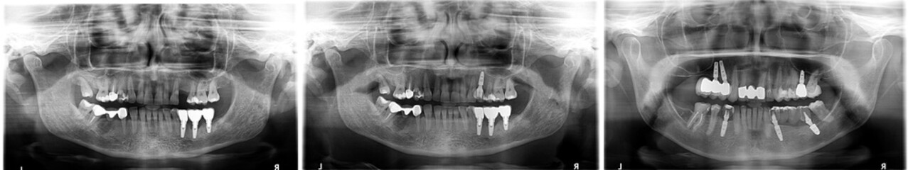 Panoramic negative image facial of old male with one implant tooth.