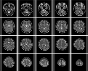 頭部MRIのサムネイル