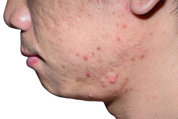 Close-up acne and scars on asian man face, isolated white background with clipping path