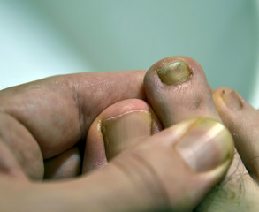 Close-up image of a fingernail on the right foot of a Caucasian man. The signs of mycosis of the...