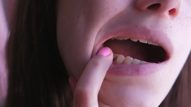 Woman shows her pain tooth. Pink tooth with caries and cured with using resorcinol-formalin paste. Old method of treatment with toxic materials. Closeup view.