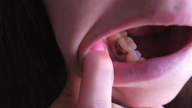 Young woman shows her pain tooth. Pink tooth with caries and cured with using resorcinol-formalin paste. Old method of treatment with toxic materials. Closeup view.