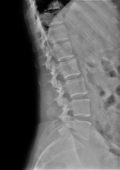 radiograph of lumbar and sacral spine in lateral projection, medical diagnostics