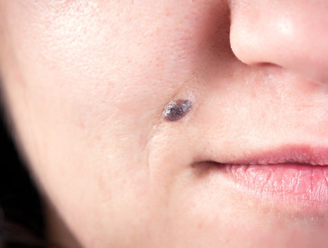 Mole on the face of woman