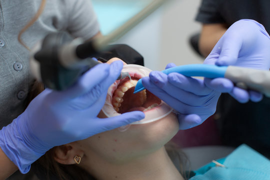 Hygienic cleaning of teeth from plaque close-up.