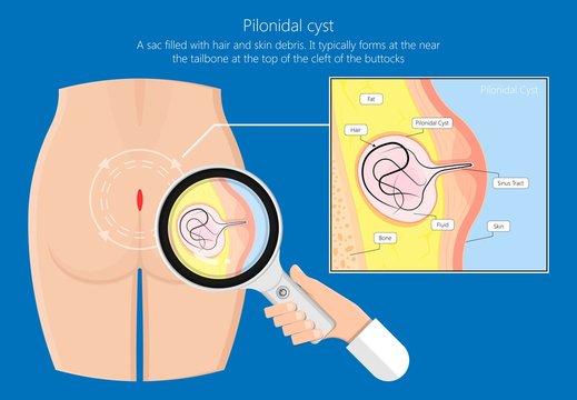 Pilonidal cyst nest of hair causes from excessive prolonged sitting diagnose and treatment
