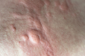 urticaria on skin. rashes, of which urticaria and toxic erythema are the most common.