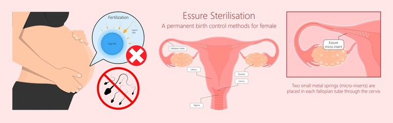 Tubal ligation surgery permanent birth control blocked prevent egg ovary tie uterine banded cauterized sterilizes block