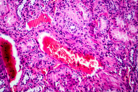 Histopathology of hypertensive renal disease, light micrograph, photo under microscope