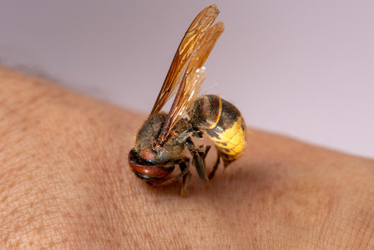 Hornet Bites A Man’s Hand