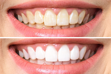 woman teeth before and after whitening. Over white background