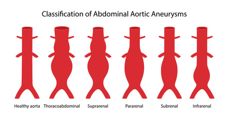 Classification of Abdominal Aortic Aneurysms. Healthy abdominal aorta and abdominal aorta with various types of aneurysm. Vector illustration in flat style isolated on white background - obrazy, fototapety, plakaty