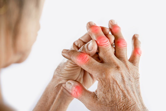 Asian woman hand suffering from joint pain with gout in finger