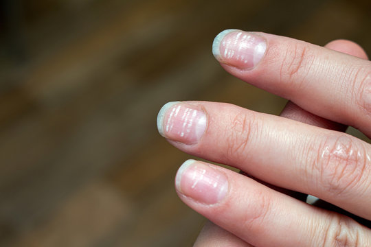 vitamin deficiency avitaminosis anemia nail problem with white dots