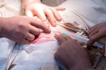 Obraz na płótnie Canvas local anesthesia. Soft tissue anesthesia during surgery