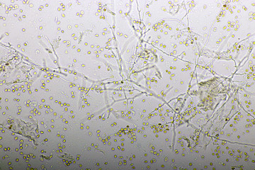 Picture of fungus and red blood cells in hemoculture tube, analyze by microscope 400x, specimen...