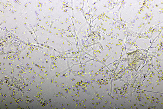 Picture of fungus and red blood cells in hemoculture tube, analyze by microscope 400x, specimen from HIV/AIDS patient