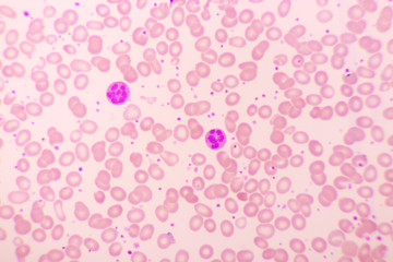 Essential thrombocytosis blood smear, present abnormal high platelet, analyze by microscope