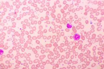 Essential thrombocytosis blood smear, present abnormal high platelet, analyze by microscope