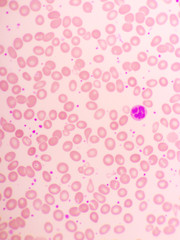 Essential thrombocytosis blood smear, present abnormal high platelet, analyze by microscope