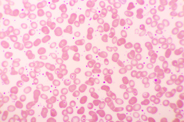 Essential thrombocytosis blood smear, present abnormal high platelet, analyze by microscope