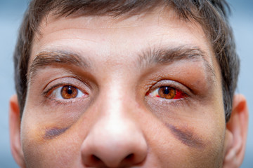 face of a white person with bruises under the eyes and an eye damaged with blood