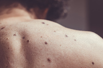 Melanocytic nevus, some of them dyplastic or atypical, on a caucasian man of 37 years old from Spain - obrazy, fototapety, plakaty