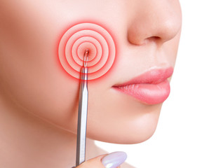 Mechanical cleaning of young female face with acne loop.