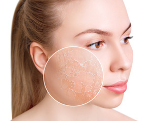 Young woman with zoom circle shows dry facial skin.