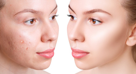 Face of beautiful woman before and after acne treatment.